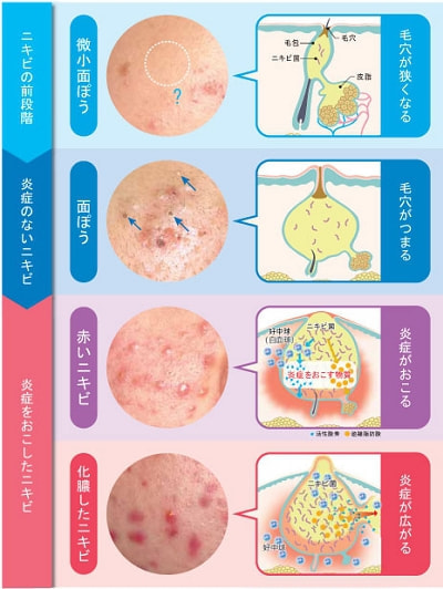 ニキビのメカニズム