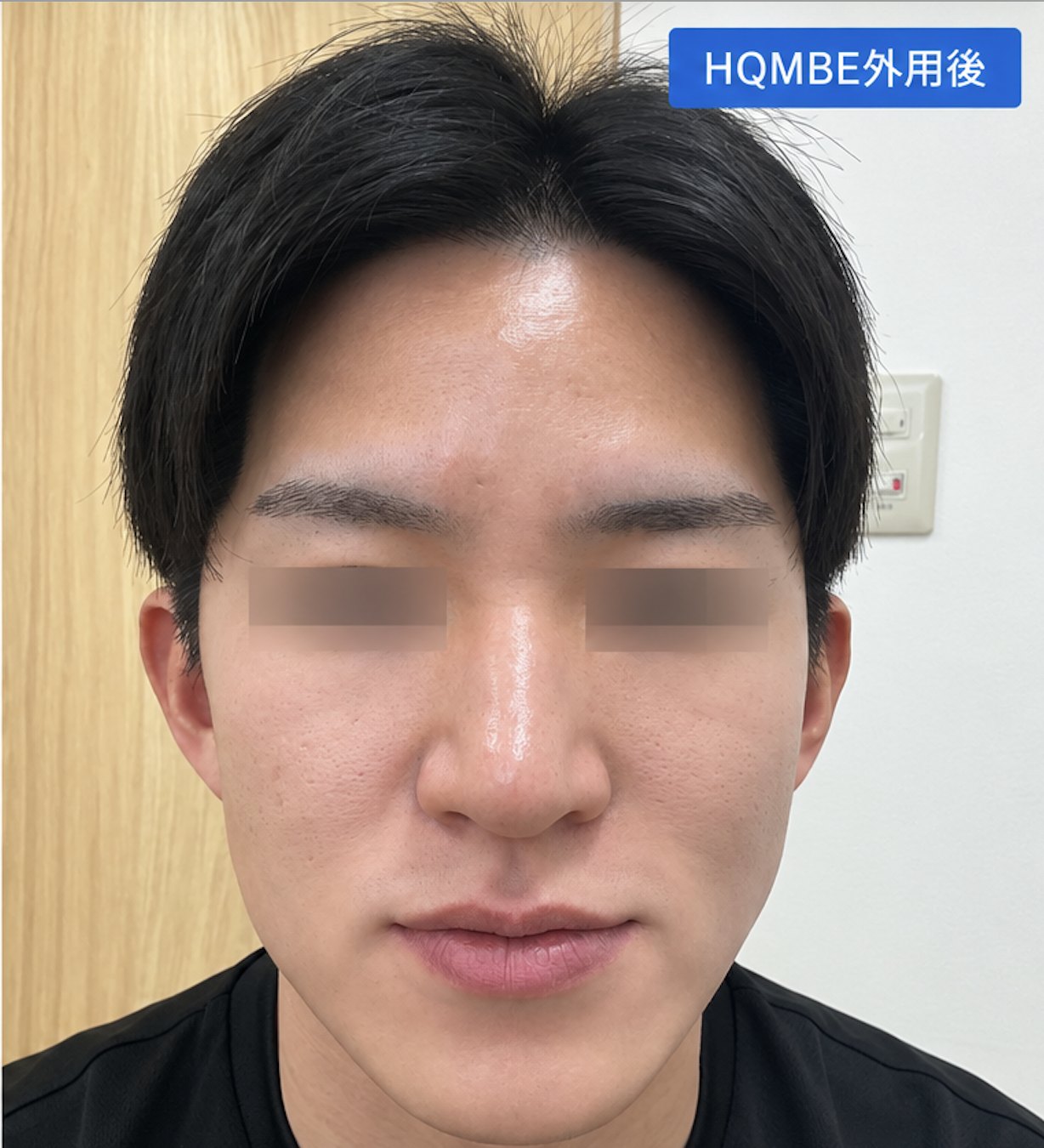 尋常性白斑の脱色療法　治療後