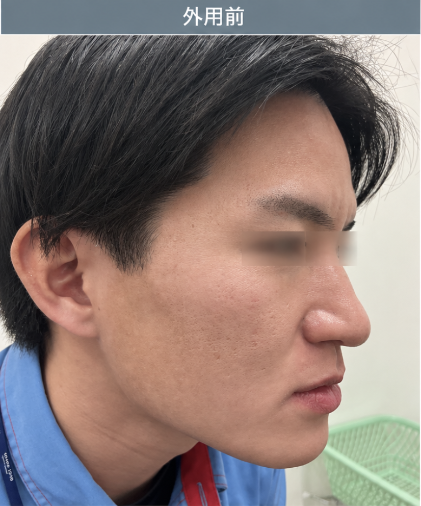 尋常性白斑の脱色療法　治療前