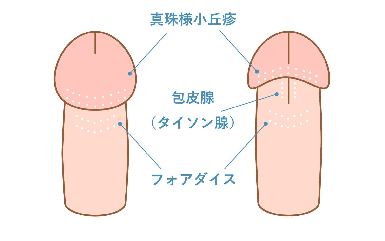 男性の陰部のブツブツの種類