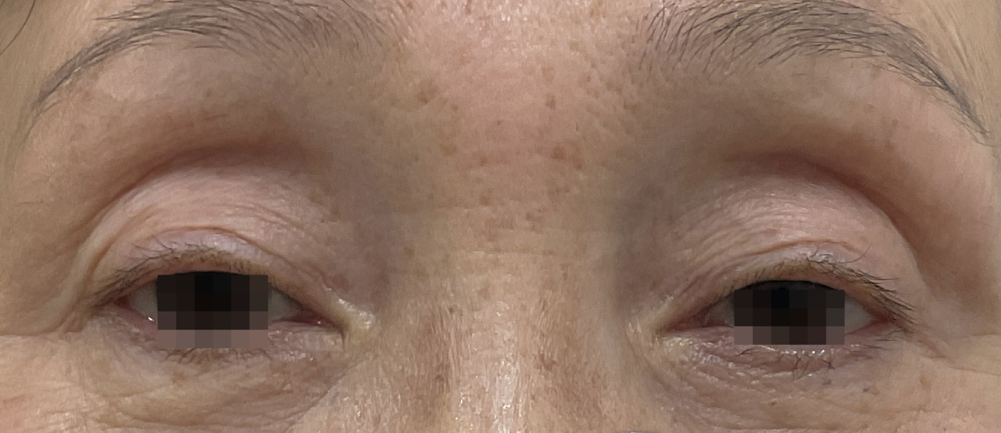 切らない眼瞼下垂施術前