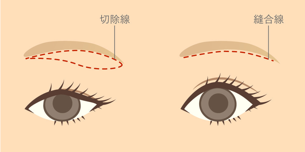 眉毛下皮膚切除術手術イメージ