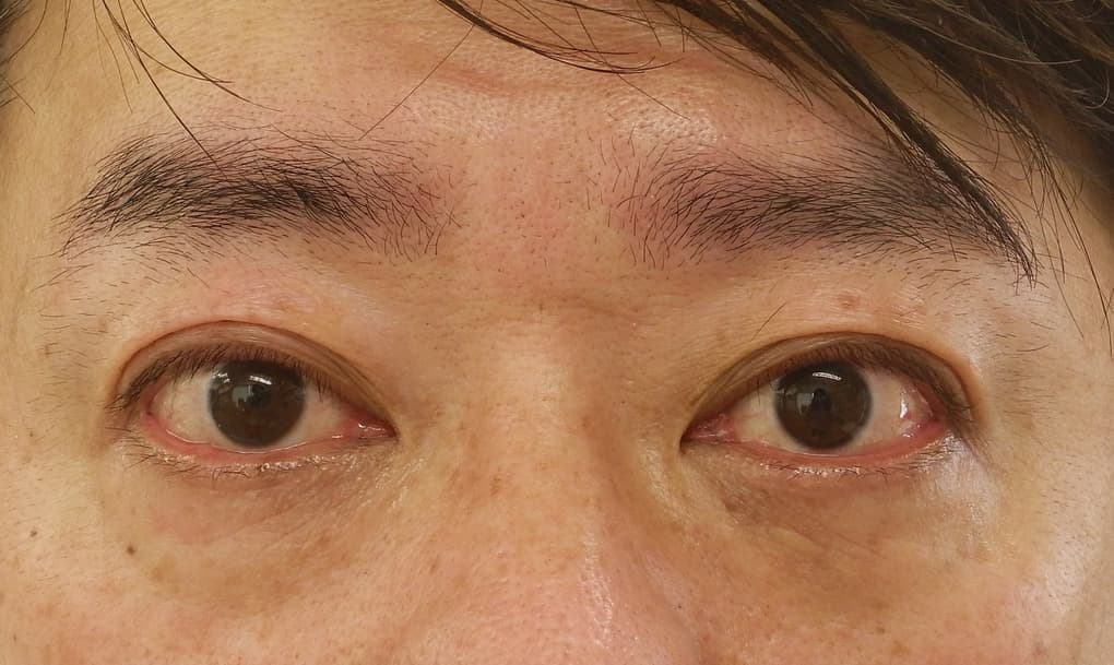 切らない眼瞼下垂施術後