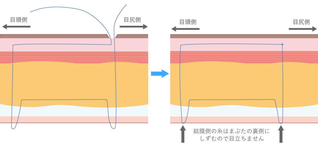 しむら皮膚科クリニックの埋没法の糸の留め方