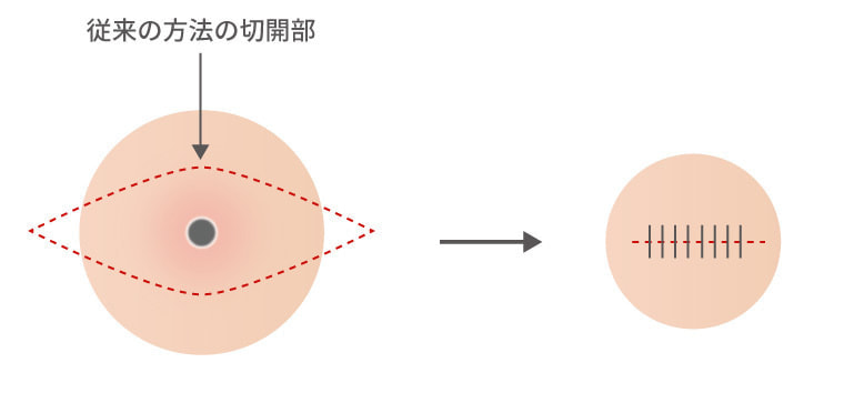 従来の手術方法