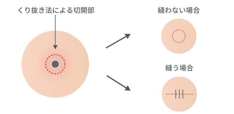 くり抜き法