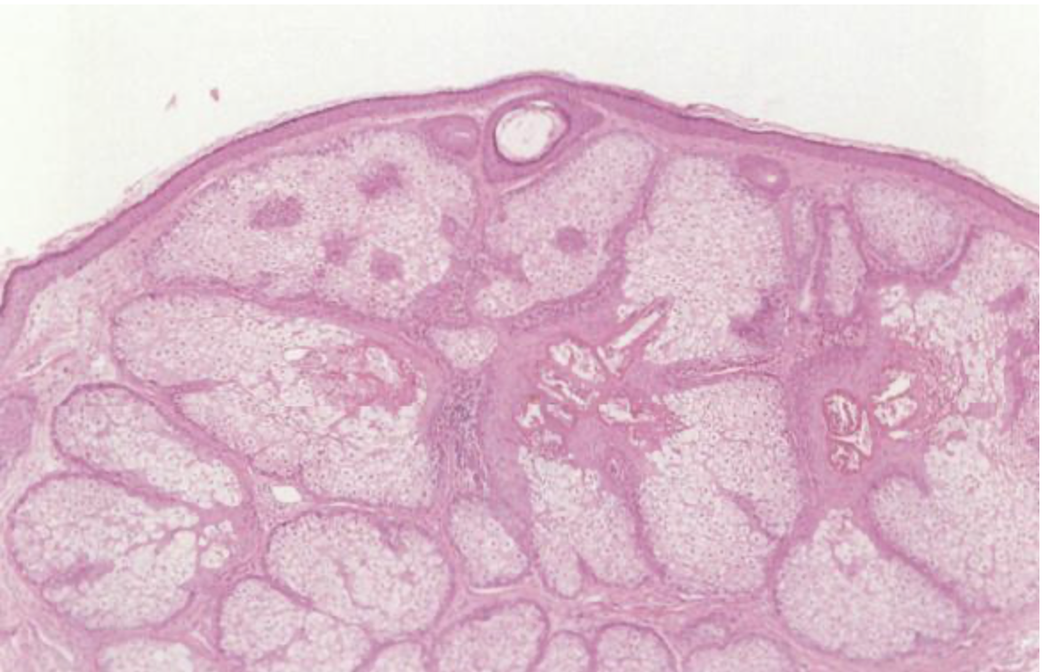 老人性脂腺増殖症の病理像